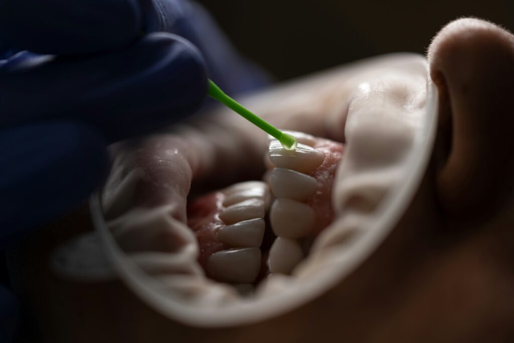 A close-up of a bright smile after porcelain veneers in Langley, BC